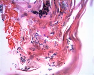 Dieses Hautbioptat zeigt das histopathologische Erscheinungsbild einer Malassezia-Otitis 